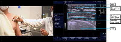 A practical guide to botulinum neurotoxin treatment of shoulder spasticity 2: Injection techniques, outcome measurement scales, and case studies